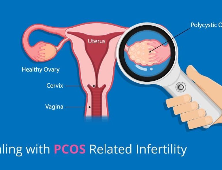 PCOS Treatment in Rohini