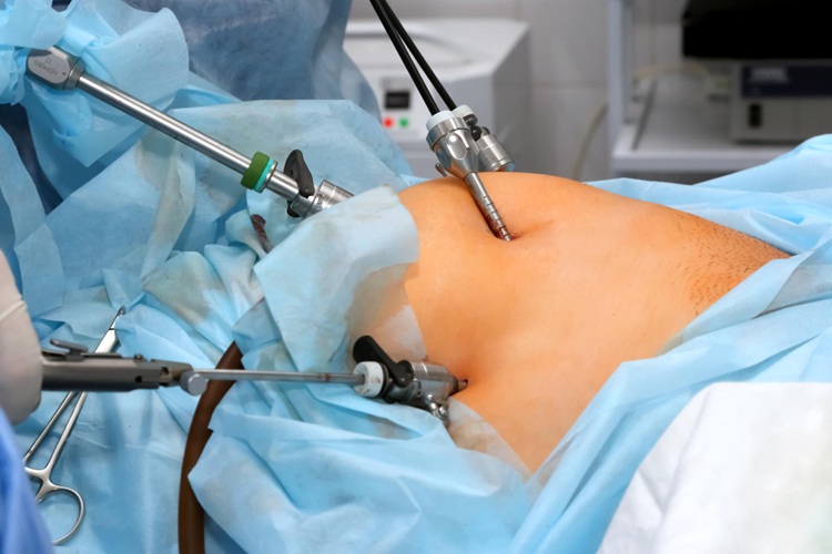Laparoscopic Surgery in Rohini
